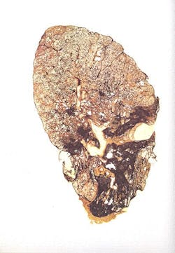 Silicosis Lung 600w Silicosis Lung 600w