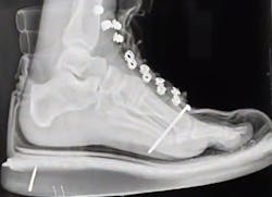 Nail through boot into foot Nail through boot into foot